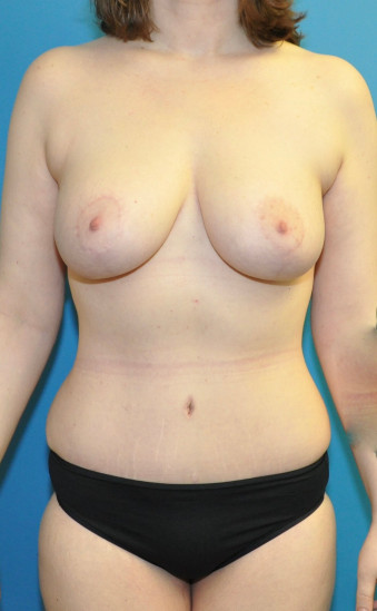 Post op breasts and body 8 months anterior