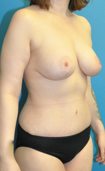 Post op breasts and body 8 months right oblique