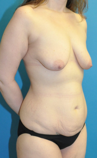 Pre op breasts and body