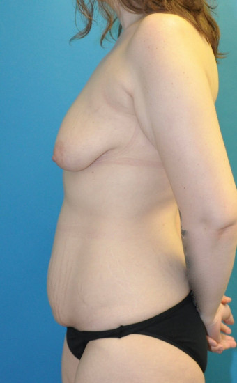 Pre op breasts and abdomen left lateral 