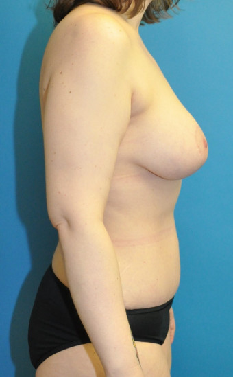 Post op 8 months breast and body right lateral 