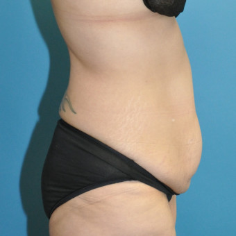 Pre op right lateral 