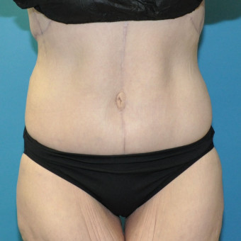Post op abdomen 1 year and bra rolls 4 months anterior