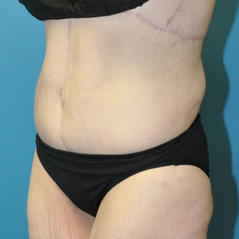 Post op lower body lift one year left oblique