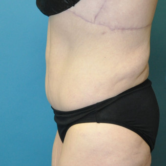 Post op one year left lateral lower body lift