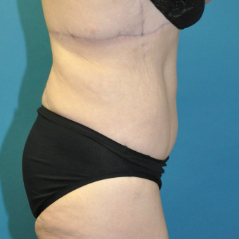 Post op one year right lateral lower body lift