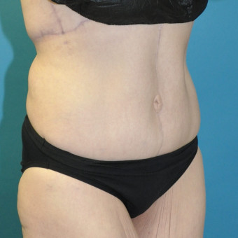 Post op right oblique one year lower body lift