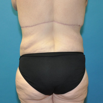 Posterior lbl one year and 4 months bra roll