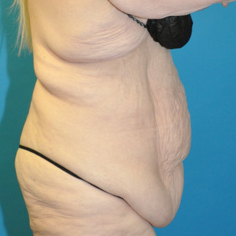 Pre op abdomen and bra roll right lateral