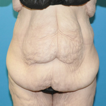 Pre op abdomen anterior 2024 use