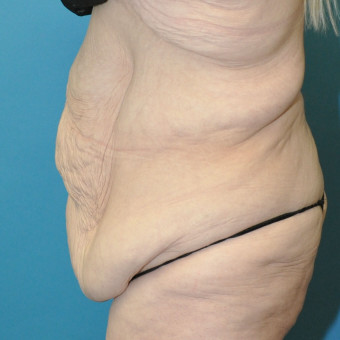 Pre op abdomen left lateral 
