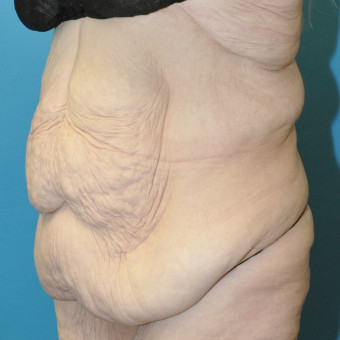 Pre op left oblique abdomen