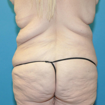 Pre op lower body lift posterior