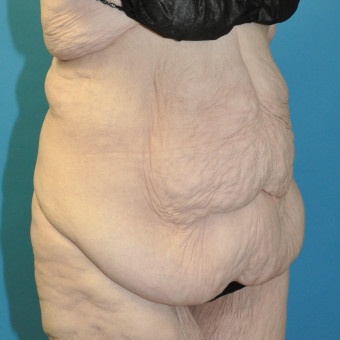 Preop abdomen and bra roll right oblique
