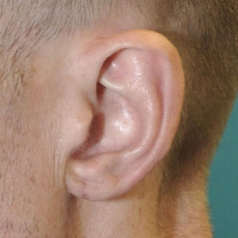 Post op left earlobe