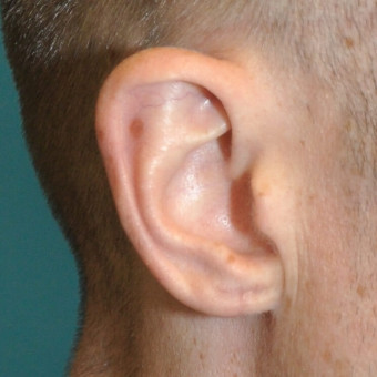Post op right earlobe