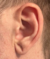 Pre op left earlobe
