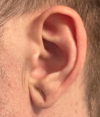 Pre op left earlobe