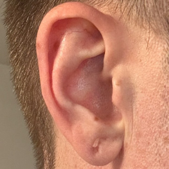 Pre op right earlobe