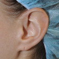 Pre op left earlobe repair