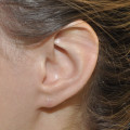left earlobe after repair 2 weeks
