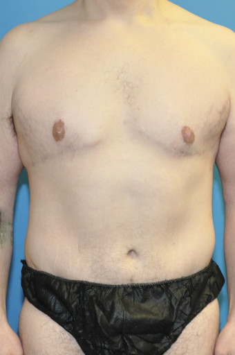 Post op 1 year anterior chest and abdomen no tatts