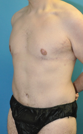 Post op 1 year chest and abdomen left oblique