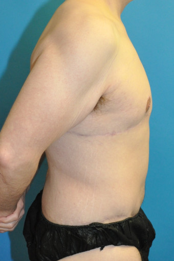 Post op one year breasts and body right lateral 