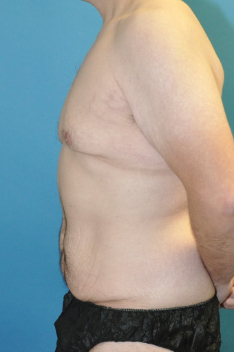 Pre op left lateral breasts and body