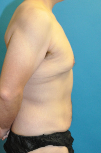 Pre op right lateral 