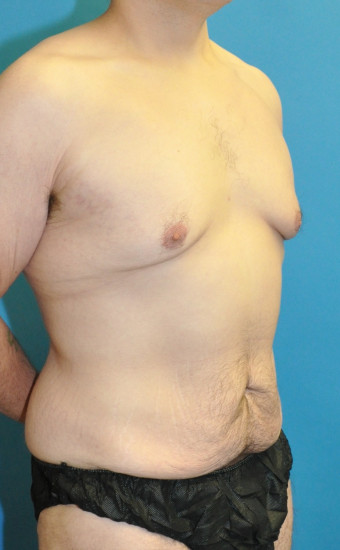 Pre op right oblique chest and abdomen