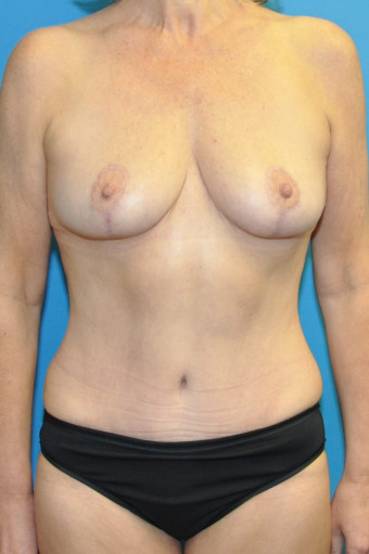 Post op breasts and abdomen anterior 7 months