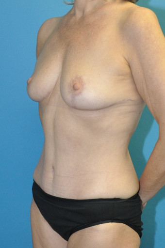 Post op breasts and abdomen left oblique 7 months
