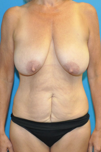 Pre op breasts and abdomen anterior