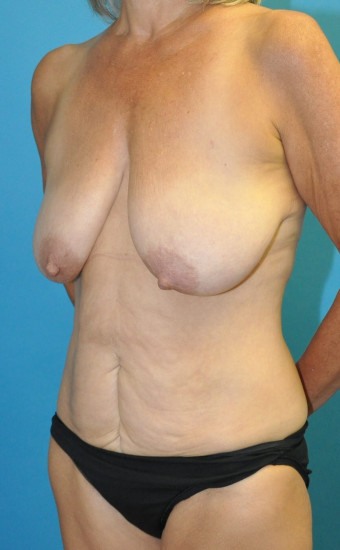 Pre op breasts and abdomen left oblique