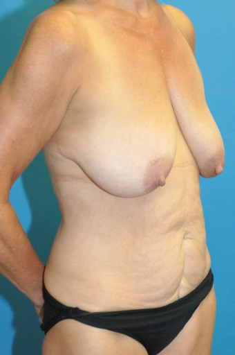Pre op breasts and abdomen right oblique