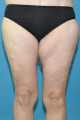 Post op 6 months thighs anterior