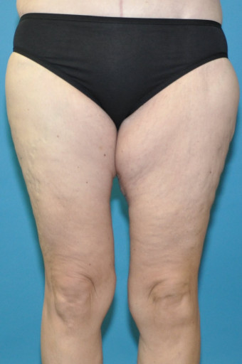 Post op 6 months thighs anterior