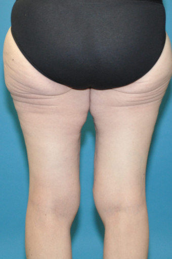 Post op 6 months thighs posterior