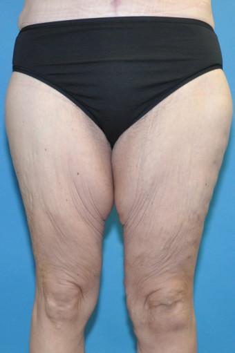 Pre op anterior thighs