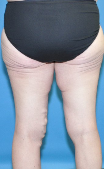 Pre op thighs posterior