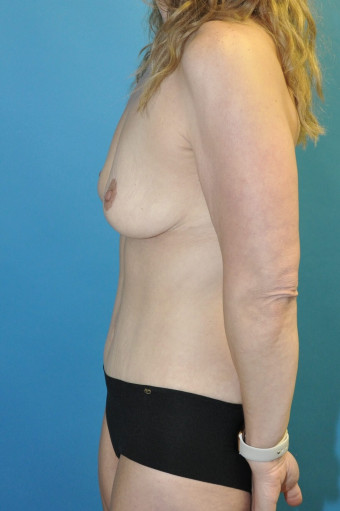 Post op left lateral 1 year