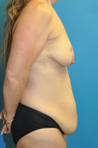 Pre op breasts and abdomen right latereal 