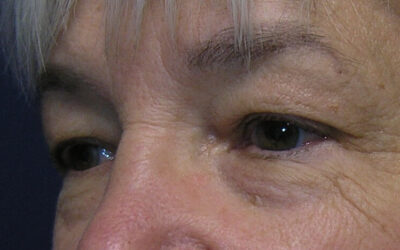 Eyelid Lift Surgery at Sound Plastic Surgery