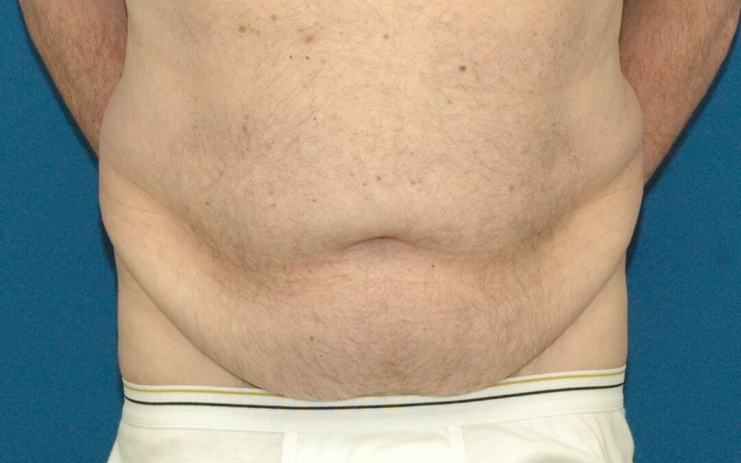 Recent Trends – Cosmetic Surgery for Men in Seattle