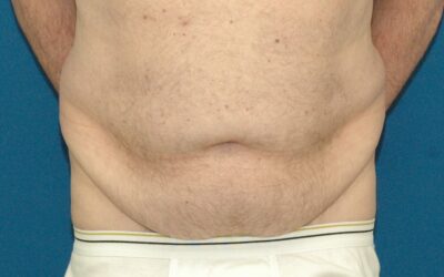 Recent Trends – Cosmetic Surgery for Men in Seattle