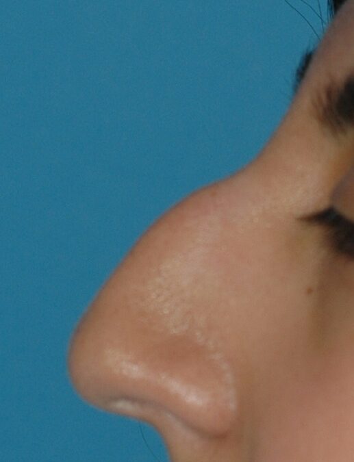 Dorsal hump removal with rhinoplasty nose surgery