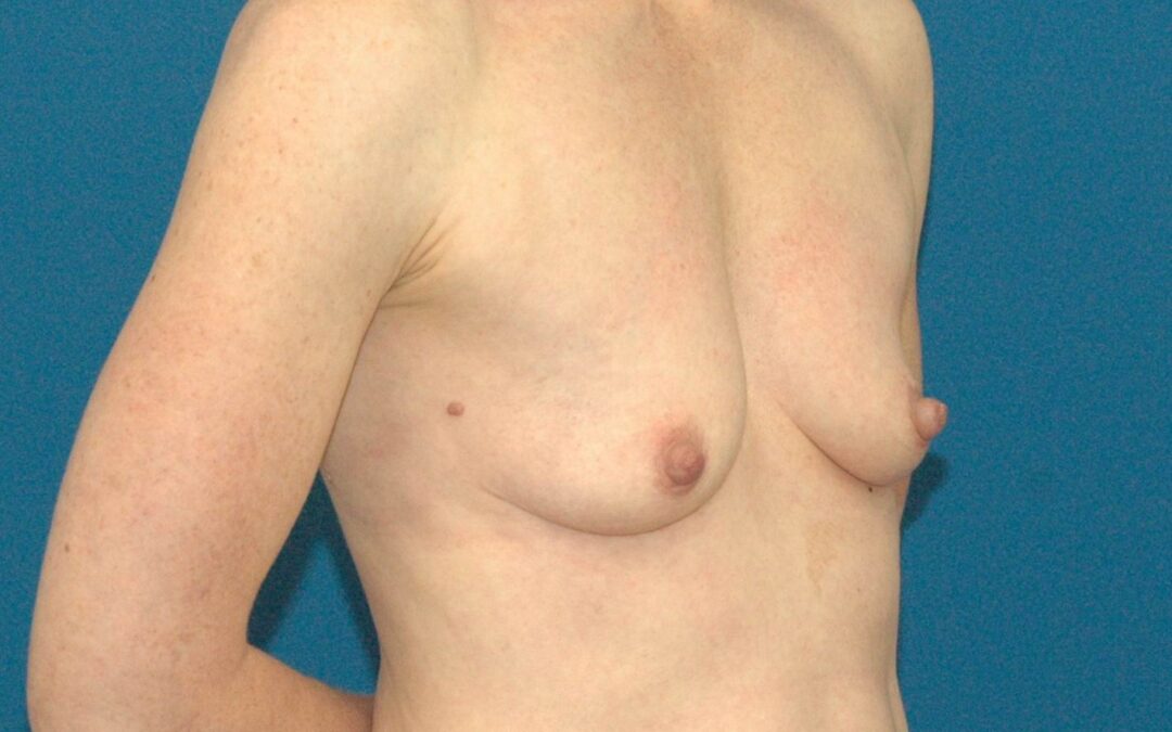 Breast Lift Surgery with the Seattle plastic surgery experts