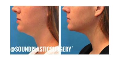 Kybella treatments at SPS