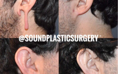 Reasons to Consider Earlobe Repair